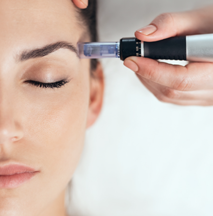 Christmas Offer Facial microneedlen de Acido Hyaluronico o PRP Salmon